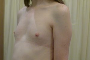 Breast Augmentation Patient_4
